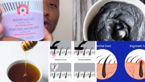 30+ Safe Treatments Get Rid Ingrown Hairs Fast