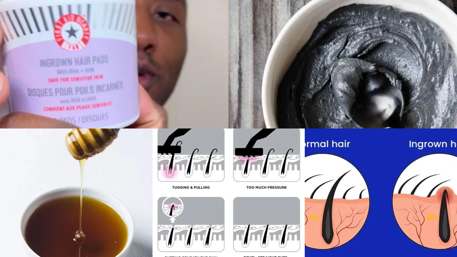 30+ Safe Treatments Get Rid Ingrown Hairs Fast